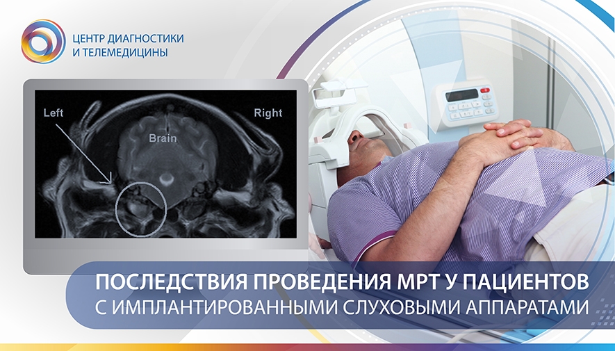 Последствия проведения МРТ у пациентов с имплантированными слуховыми аппаратами