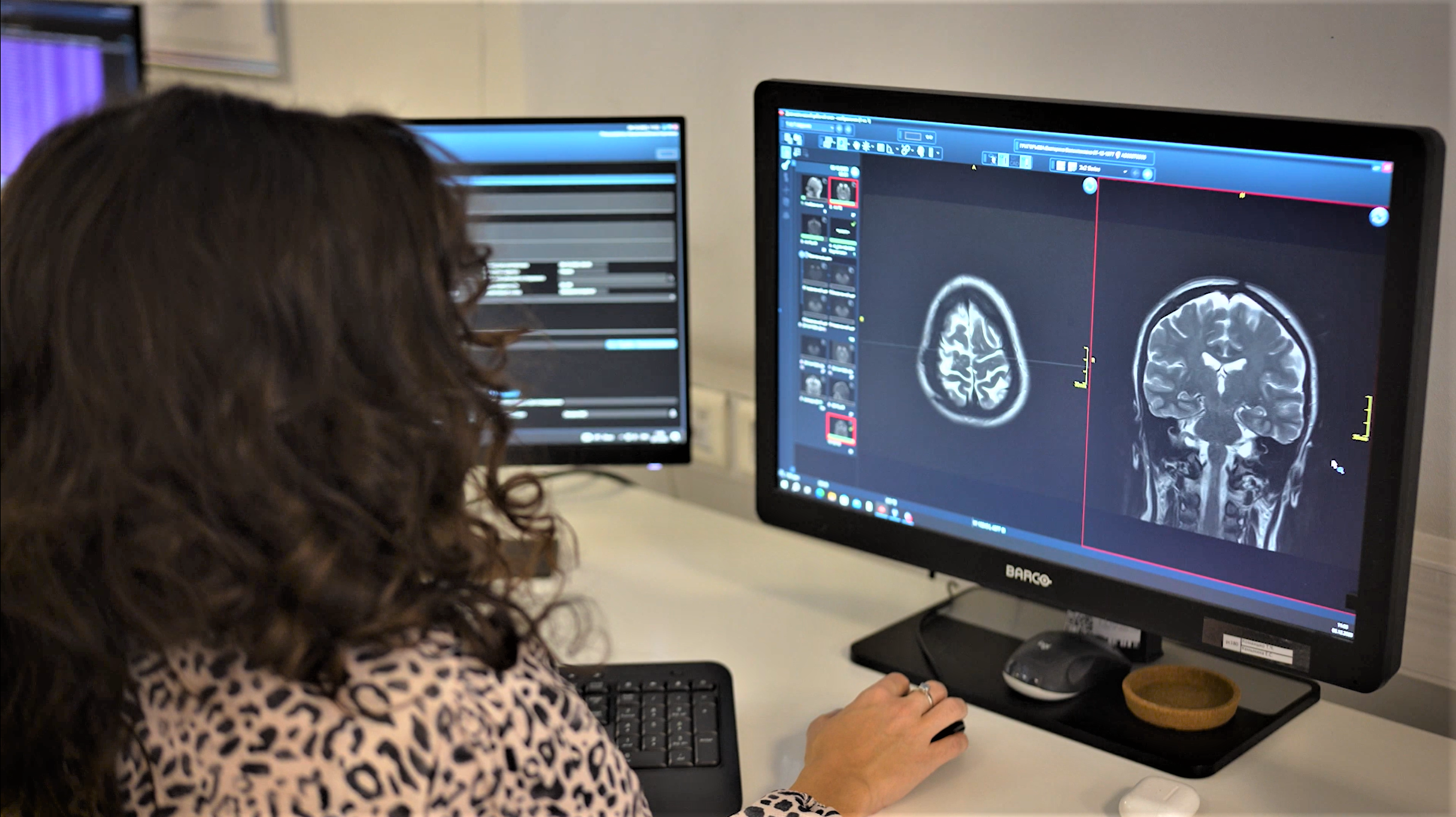 В Москве запустили первые комплексные сервисы искусственного интеллекта для поиска заболеваний головного мозга